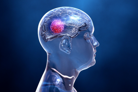 Brain Tumors | Neuro Medical Clinic of Cenla
